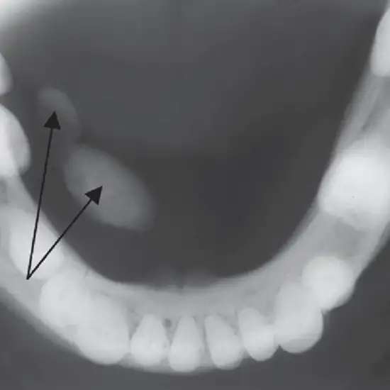 x-ray right submandibular occlusal view test